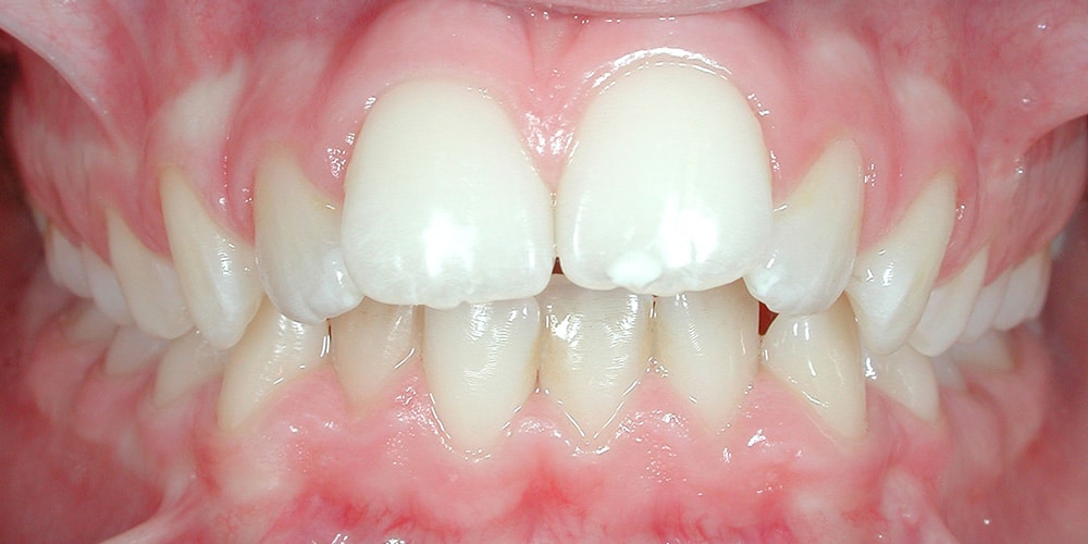 Cas clinique – Correction classe II squelettique et dentaire
