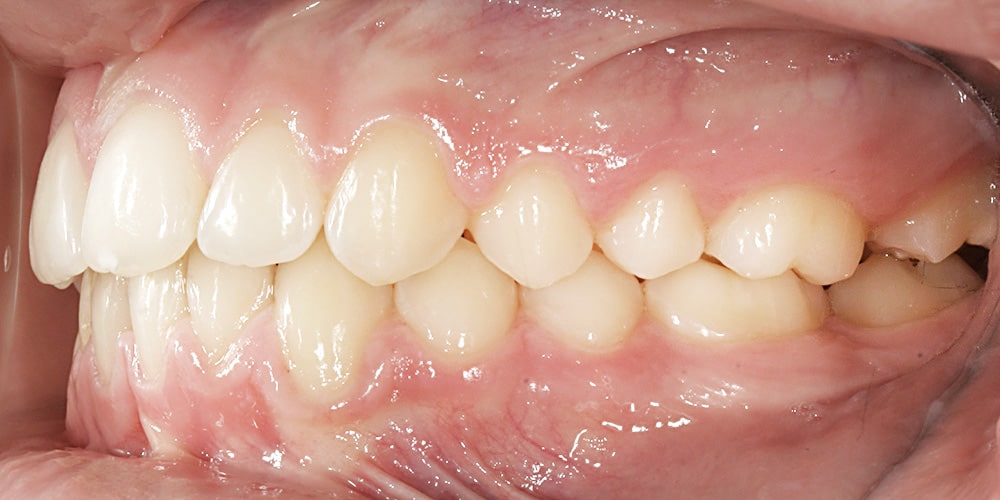 Cas clinique – Correction classe II squelettique et dentaire