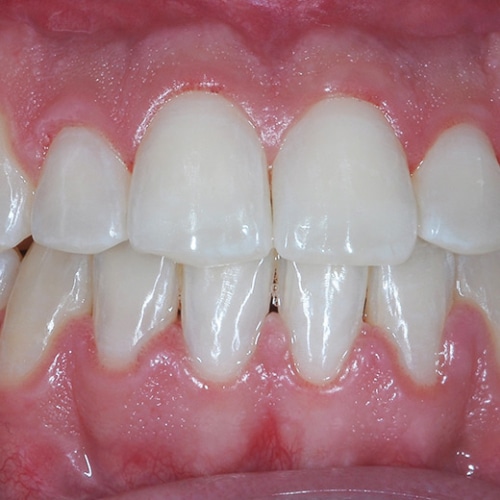 Cas clinique – Correction chirurgicale classe III squelettique et dentaire